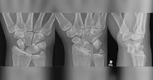 Image result for Lunate Dislocation