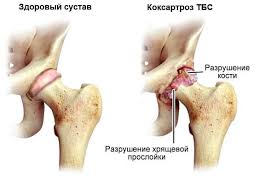 Koksartroz Tazobedrennogo Sustava Lechenie Operaciya Cena V Spb