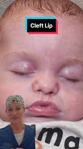 Image result for Cleft Lip