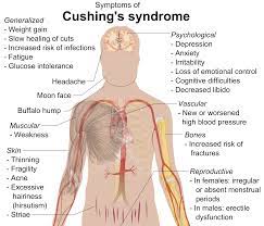 Difference Between Cushing S Disease And Cushing S Syndrome Difference Between