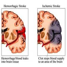 Bildergebnis für CVA