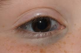 Ota Nevus Dr Gunes Erturk