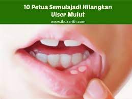 Ulser mulut adalah sebarang jenis ulser yang terjadi di dalam rongga mulut. 10 Cara Semulajadi Menyembuhkan Ulser Mulut Yang Banyak Diari Ibuzarith