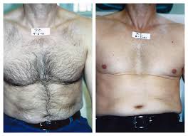 You know if hair grows your bodyes then you face many problems.bassically our private areas hair such as bikini line, brazilian, pubic area, etc. Laser Hair Removal For Men Laser Hair Pittsburgh Happel Center Laser Hair Removal