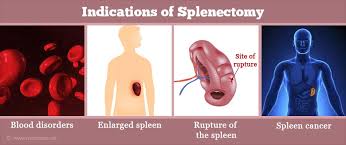 Spleen enlargement, as seen in conditions where the blood cells accumulate in the spleen and other medical conditions such as mononucleosis, liver disease, blood cancers and other infections.; Splenectomy Spleen Removal Types Indications And Complication