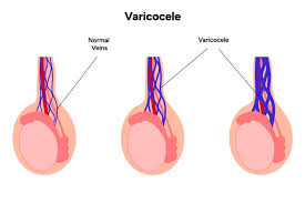 Image result for Varicocele
