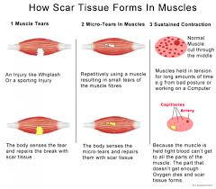 How Scar Tissue Forms In Muscles Infographic Massage Therapy Scar Tissue Massage Benefits