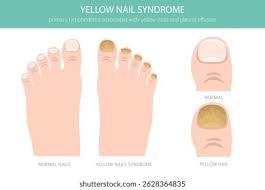 Image result for Yellow nail syndrome feet