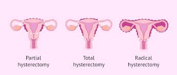 This procedure may help in relieving symptoms, but it prevents you to bear child. Becoming A Mother After Hysterectomy How To Do It