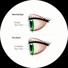 Image result for Dry Eye