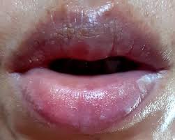 よくあるご質問 | 剥脱性口唇炎の漢方治療