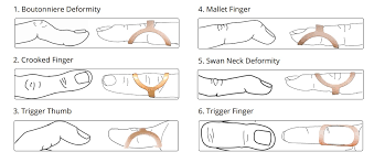 Oval-8 Finger Splint - Individual Splint - Boutonniere Deformity