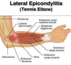 Tennis elbow is commonly triggered by overuse of the muscles and tendons of the forearm, near many people who get tennis elbow work in a way or play sport that involves moving their arm in a visit your doctor or physiotherapist if the pain continues after you have rested the elbow for one to. Tennis Elbow Hand Physiotherapy