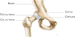 Arthroplastie totale de hanche (a), causes de reprise. Butee De La Hanche