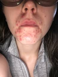 These two areas are almost universally known to be the biggest areas for hormonal acne. Buh Bye Hormonal Acne With Esthetician Hailey Severn The W Spa