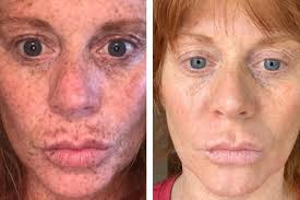 Some parts of the skin become darker compared to the immediate surrounding skin. This Dark Spot Serum Has Changed The Lives Of Over 4 000 Shoppers