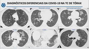 Streptococcus pneumoniae (j13) is the most common bacterial cause of pneumonia in all age groups except. Ensino E Pesquisa Einstein Live Achados De Imagem Da Covid 19 Na Tomografia Computadorizada Tc De Torax Facebook