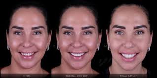 Smile makeover with 10 ceramic veneers