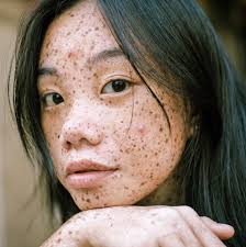 Brufoli da stress: come riconoscerli e come curarli | Amica