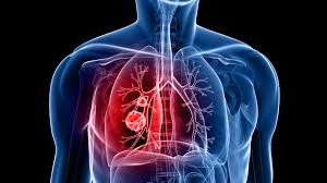 Reduced airflow affects people's ability to breathe and function as the condition. Copd N Overview Of Progressive Lung Disease Health Europa