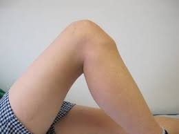 Figure 1 Klinik Bildgebung Und Therapie Des Morbus Osgood Schlatter Springerlink