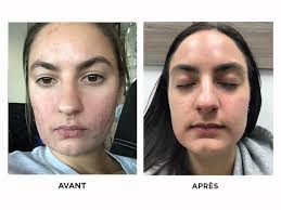 Ce peeling visage par microdermabraison redonne un nouveau souffle à votre peau et permet de la peeling peau neuve la microdermabrasion consiste à éclaircir le teint et atténuer les imperfections. Etude De Cas L Acne De Lea Blog De Espace Skins Montreal Soins Medico Esthetiques Du Visage Et Du Corps Montreal