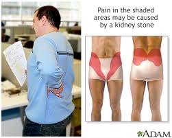 Kidney Stones Self Care Information Mount Sinai New York