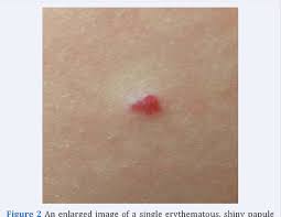 It is also known as senile angioma or a campbell de morgan spot, a type of benign (not cancerous) skin growth. Pdf A Case Of Multiple Halo Cherry Hemangiomas A Novel Entity With Histopathologic Correlation Semantic Scholar