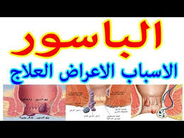 الباسور الداخلي والخارجي اسبابة واعراضة وعلاجة Youtube