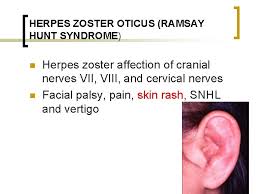 Look for a vi nerve palsy or other long tract or other cranial nerve signs which would isolate the lesion to the pons and suggest a central lesion. Complications Of Facial Paralysis N Facial Paralysis Severely