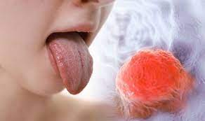 Triệu chứng cực kỳ lạ lùng, giáo sư nhớ lại. Bá»‹ Loet á»Ÿ LÆ°á»¡i Khong Tháº¥y Ä'au Co Pháº£i La Biá»ƒu Hiá»‡n Cá»§a Bá»‡nh Ung ThÆ° Vinmec