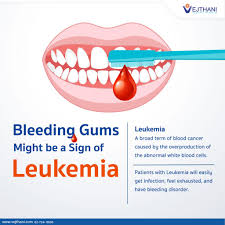 Image result for gums cancer symptoms