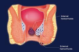 Image result for hemorrhoids