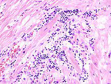 Die myokarditis ist eine entzündliche erkrankung des herzmuskels. Pathology Heart Wikibooks Open Books For An Open World