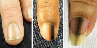 Image result for Acral lentiginous melanoma nail