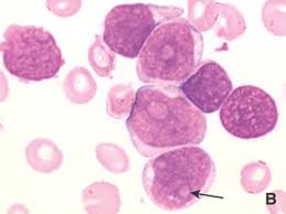 También afecta a adultos de todas las edades. Leucemia Linfoblastica Aguda Del Nino Y Del Adolescente Clinica Y Tratamiento Sciencedirect
