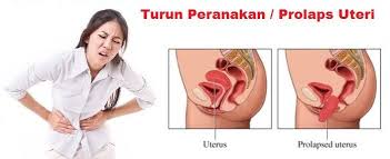 Peranakan jatuh boleh terjadi kepada wanita selepas bersalin. Get Rahim Turun Seperti Apa Png Pbsafety