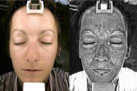Uv Damage To Face Caused By The Sun Only Visible With Special Lens Camera Base Tan Sun Tanning Tips Pale People
