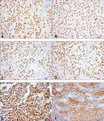 Orange represents kidney cancer and leukemia. Practicability Of Clinical Application Of Bladder Cancer Molecular Classification And Additional Value Of Epithelial To Mesenchymal Transition Prognostic Value Of Vimentin Expression Journal Of Translational Medicine Full Text