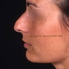 Photos avant-après chirurgie du visage et ORL