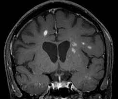 Multiple sklerose multiple sclerosis radiologie demyelination disease mri mrt Therapie Der Multiplen Sklerose Bildgebung Erkennt Lebensbedrohliche Nebenwirkung Monitor Versorgungsforschung