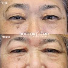 Image result for xanthelasma of eyelid