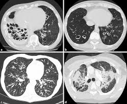 Aspergillosis is a fungal infection of usually the lungs, caused by the genus aspergillus, a common mold that is breathed in frequently from the air around, but does not usually affect most people. Chronische Infektionen Der Lunge Springerlink