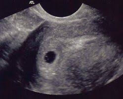 The 6 weeks of pregnancy. Ultrasound Sonogram Scans Week By Week First Trimester Month 1 2 3 Weeks 4 12 Early Baby Ultrasound Pictures Ultrasound Pictures 4 Weeks Pregnant Ultrasound
