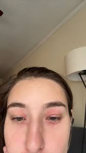 Hi guys!👋 After almost 6 years with nearly 75% coverage of plaque  psoriasis and trying an untold amount of topical treatments and light  therapy also, I was finally prescribed cyclosporine in June