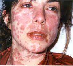 Sjs Ten Images Stevens Johnson Syndrome Foundation