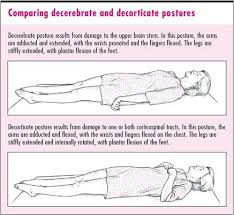 Decorticate Vs Decerebrate Posturing Nursing Study Guide Acute Nursing Medical Knowledge