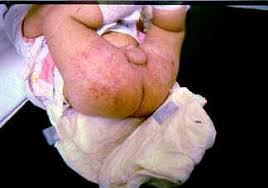 Image result for newborn diaper rash