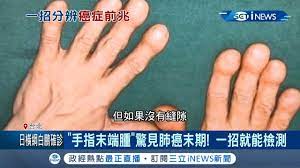 身體微恙是警訊！手指末端腫大恐為癌症前兆抬頭紋.耳垂皺紋可能是