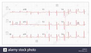 Heart Cardiogram Chart Vector Set Healthy Heart Rhythm